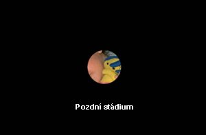 Pozdní stádium